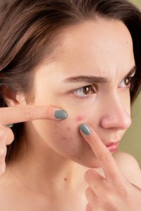 acne and how to deal with it