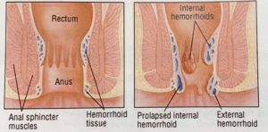 hemorrhoids