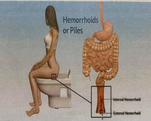hemorrhoids