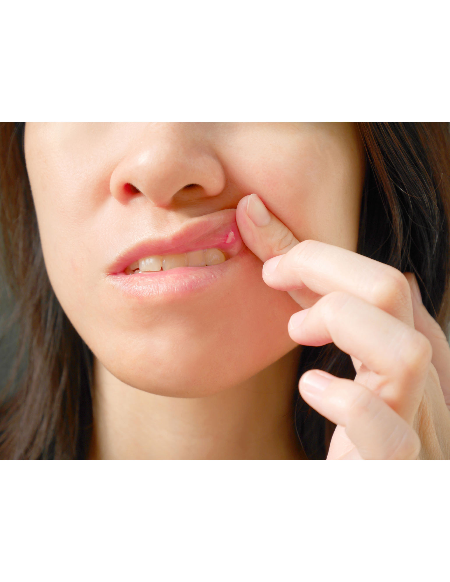 Canker Sores Understanding